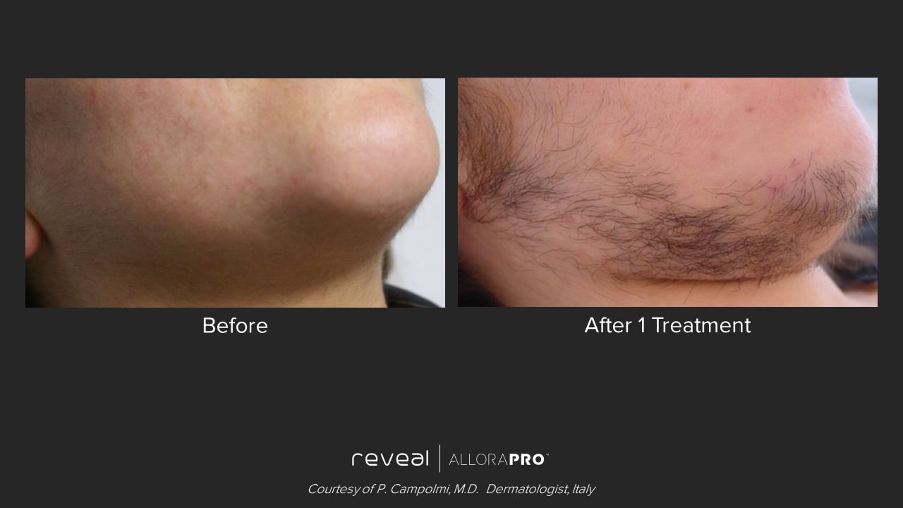 allorapro before and after 4