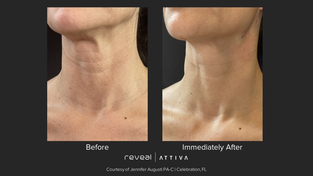 Attiva before and after 15