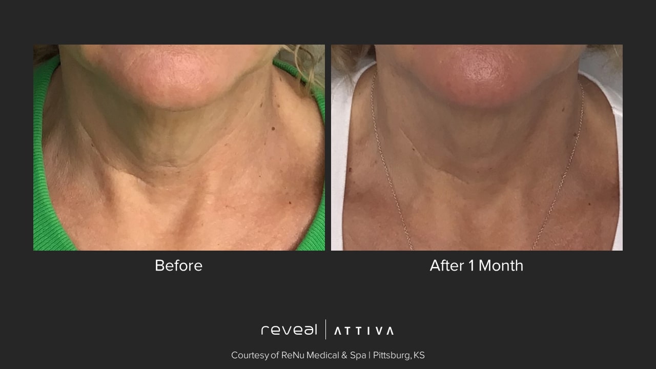 Attiva before and after 18