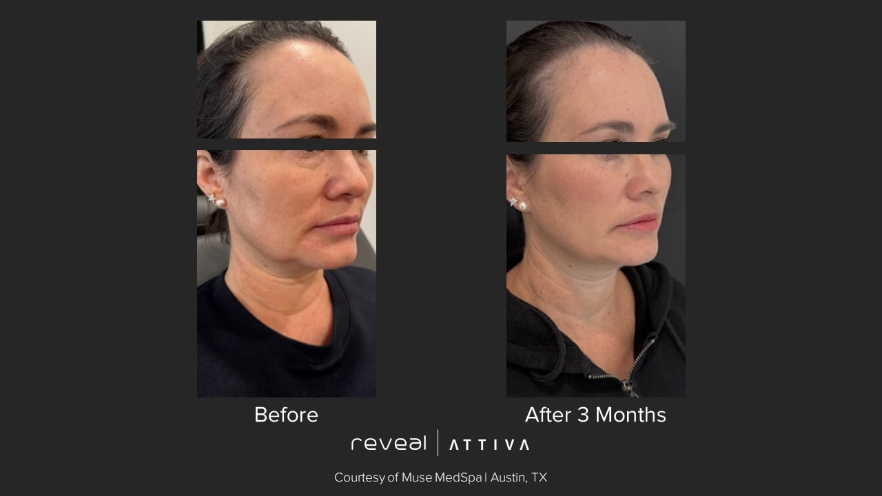 Attiva before and after 2