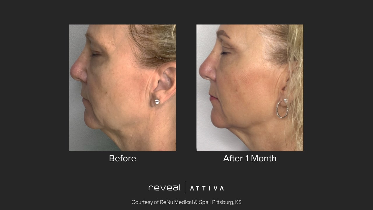 Attiva before and after 20