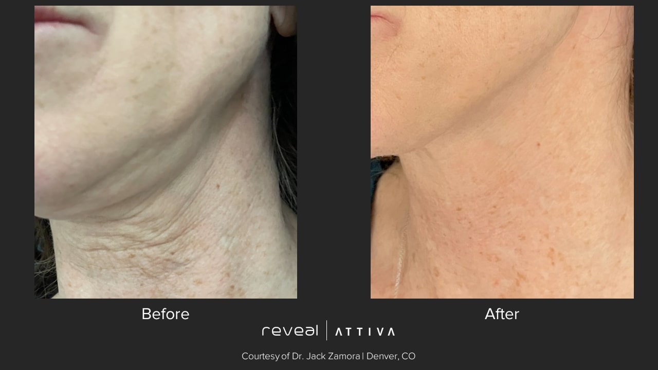 Attiva before and after 23