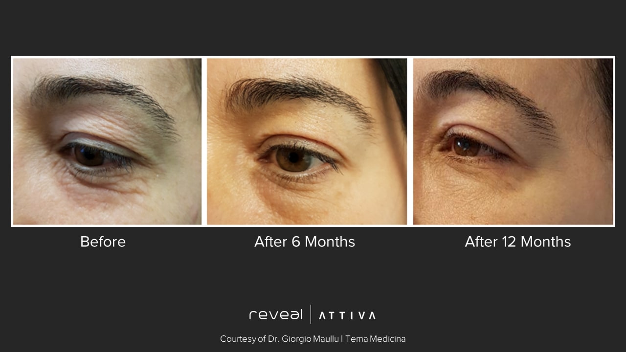 Attiva before and after 24