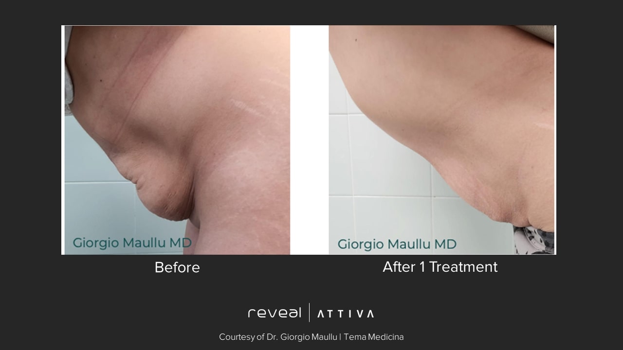 Before and after Attiva results