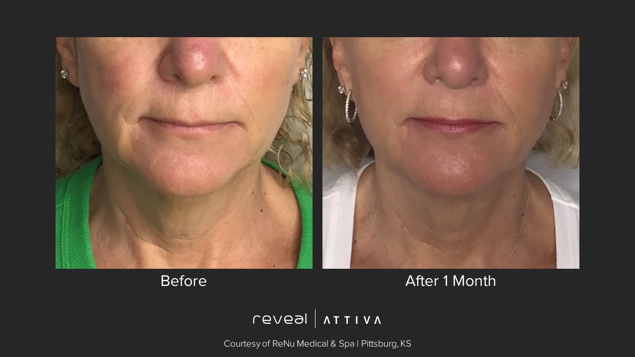 Before and after Attiva results