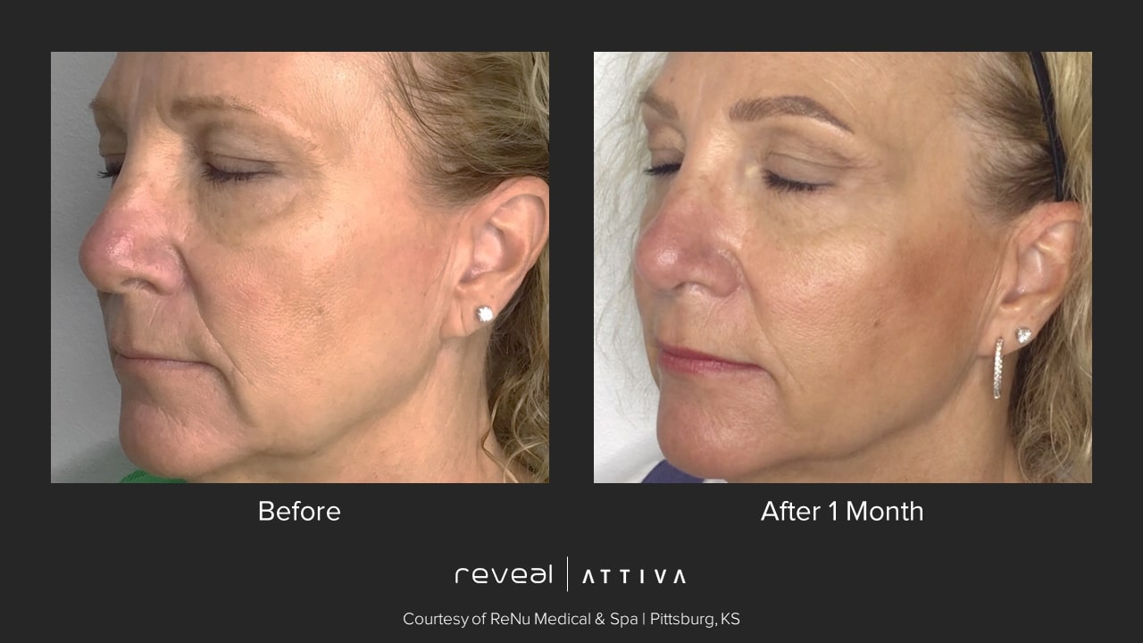 Before and after Attiva results