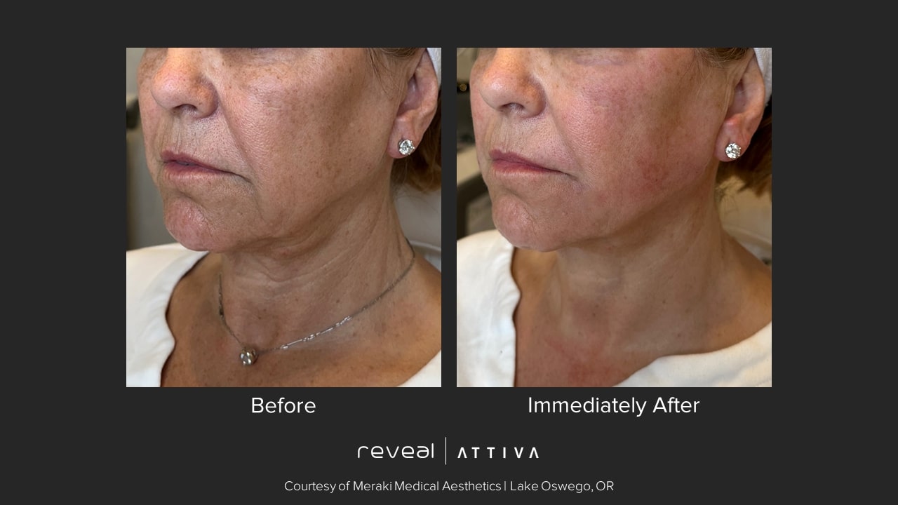 Before and after Attiva results