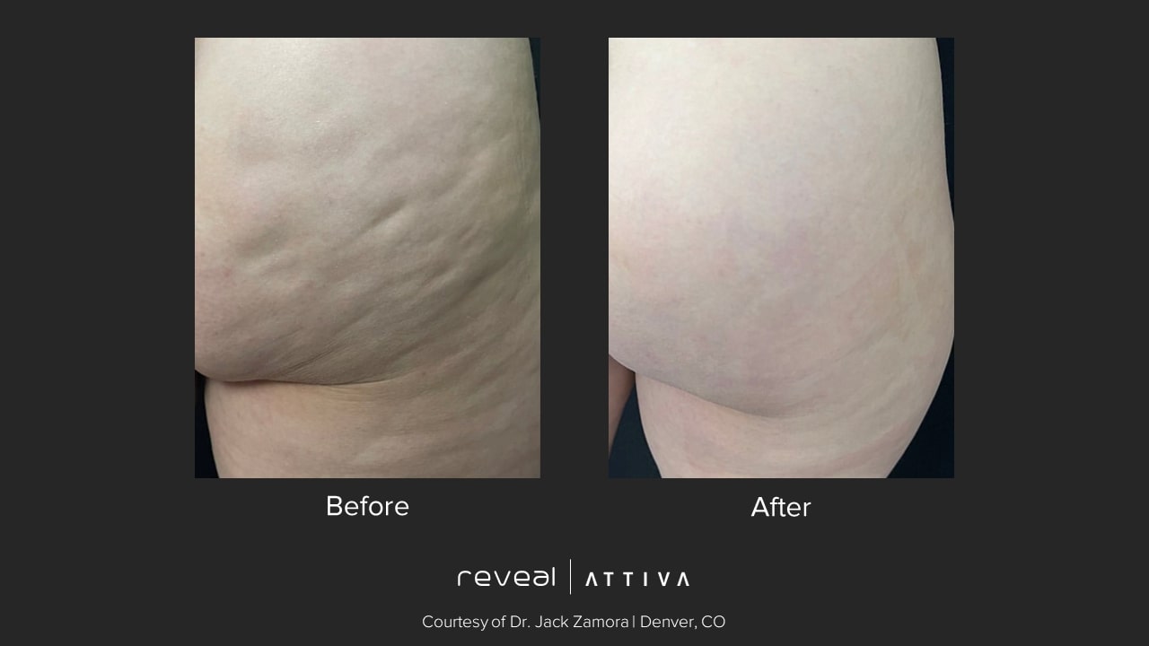 Attiva before and after body 2