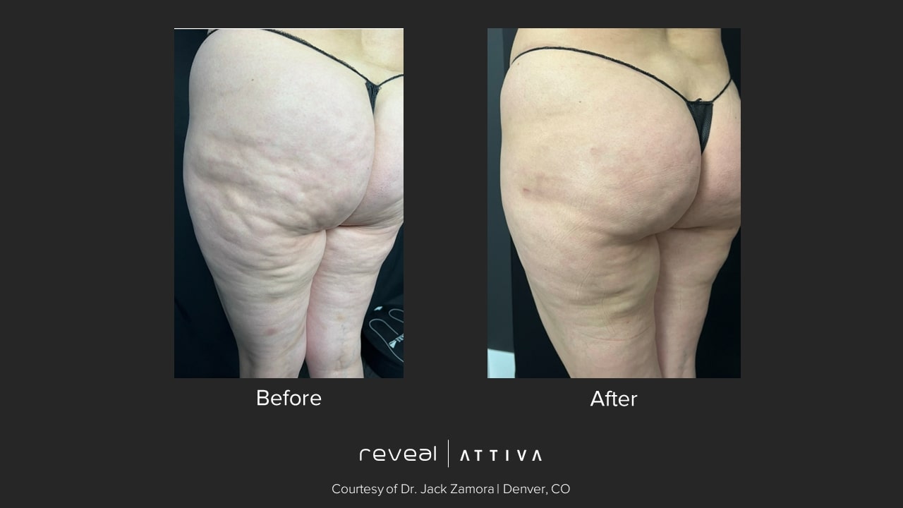 Attiva before and after body 3