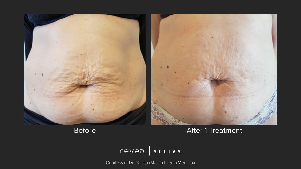 Attiva before and after body 5