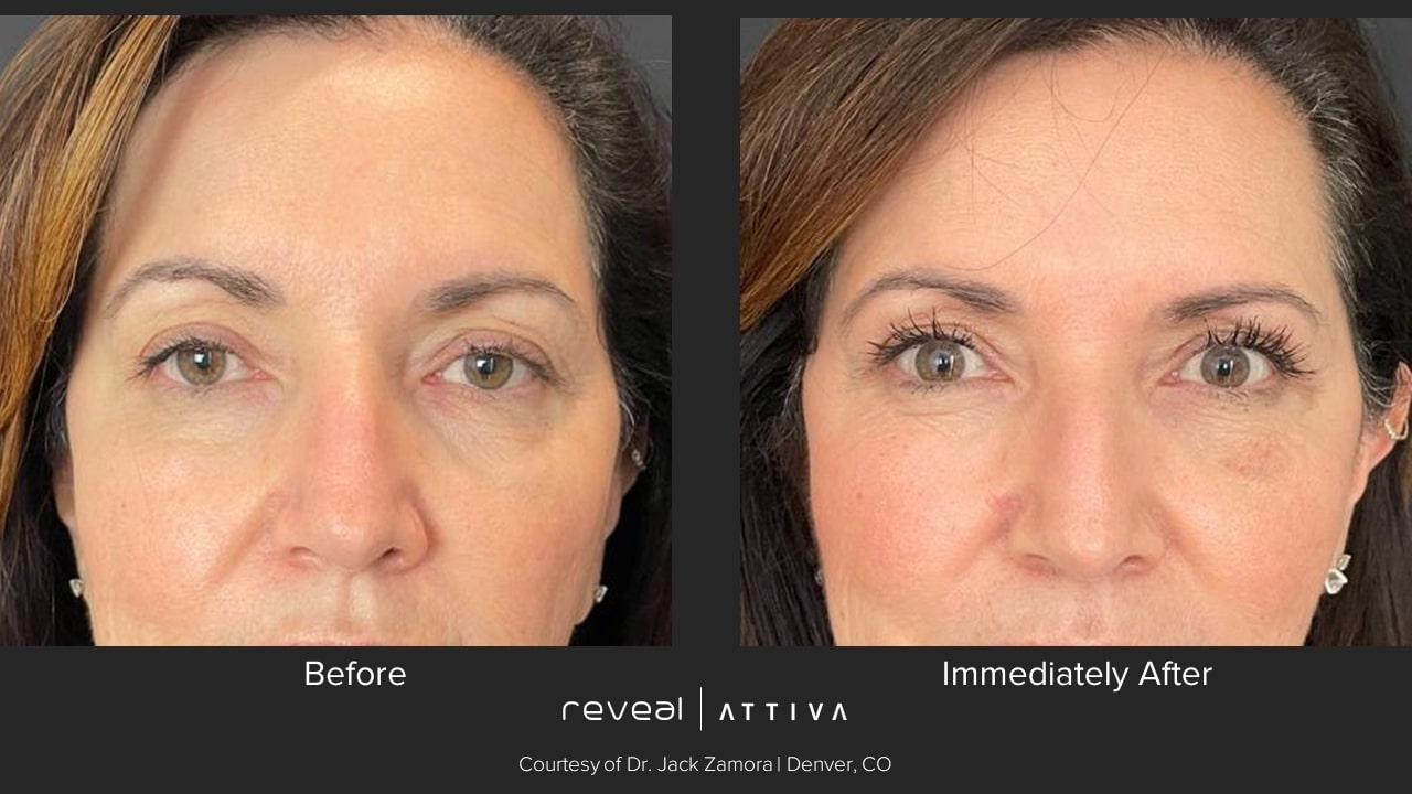Attiva before and after 1