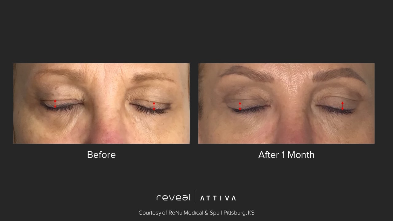 Attiva before and after 11