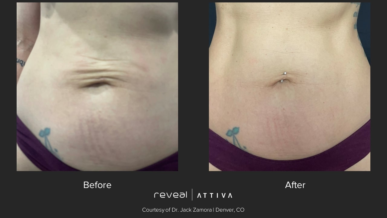 Attiva before and after 3