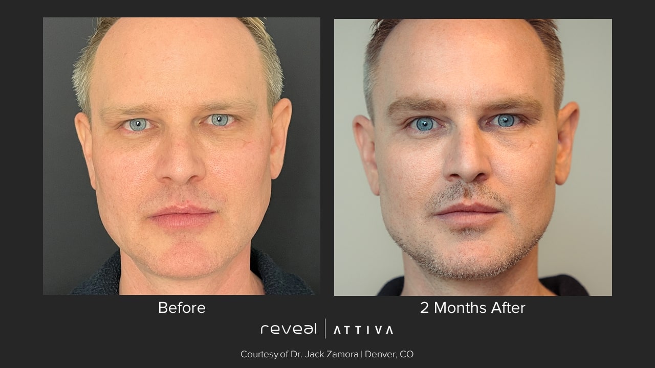 Attiva before and after 8