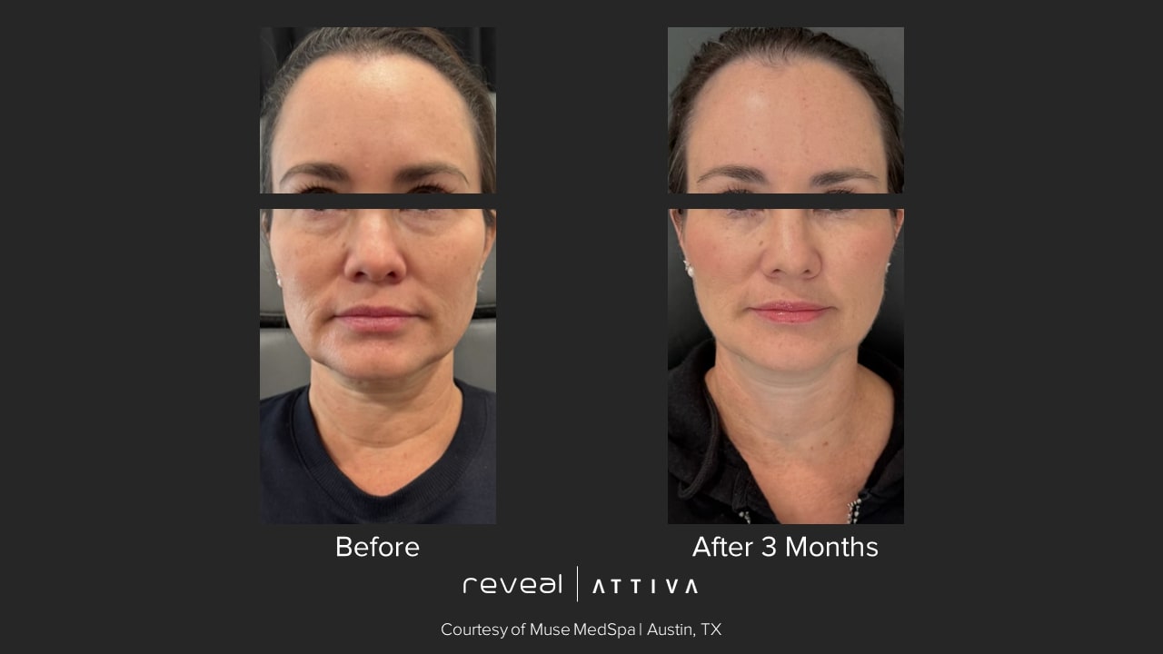 Attiva before and after 9