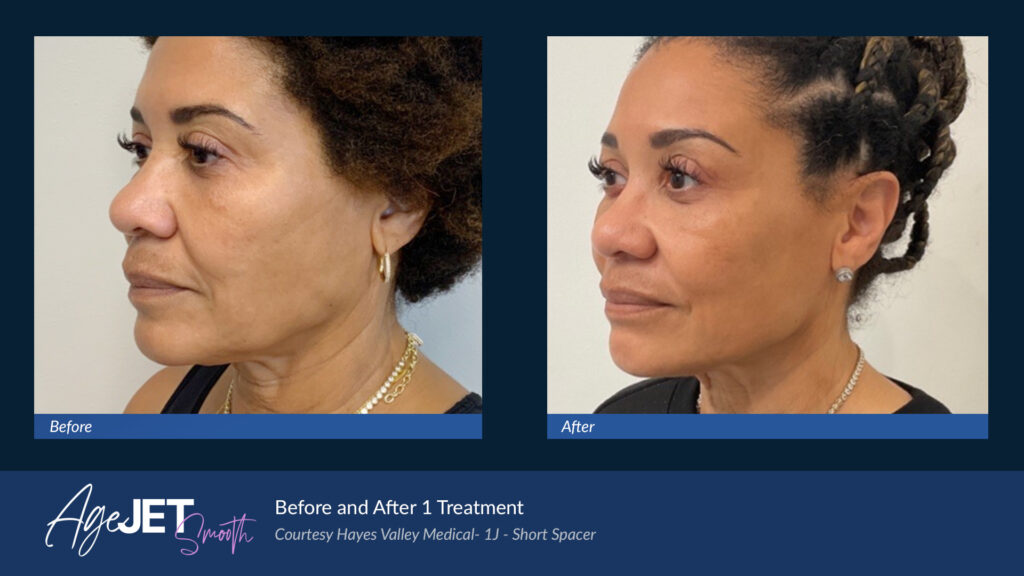 Before and after AgeJET results